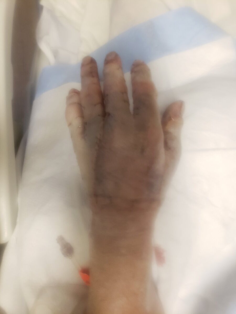 HCMC Burn unit Page 3 General Chat Red Power Magazine Community